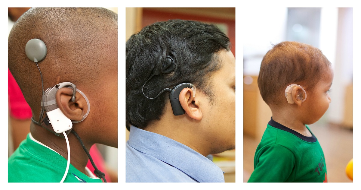 Baha Fitting Bone Anchored Hearing Aid In Delhi Noida Patna