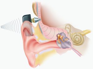 The Bone Anchored Hearing Aid (BAHA)is a surgically implanted system